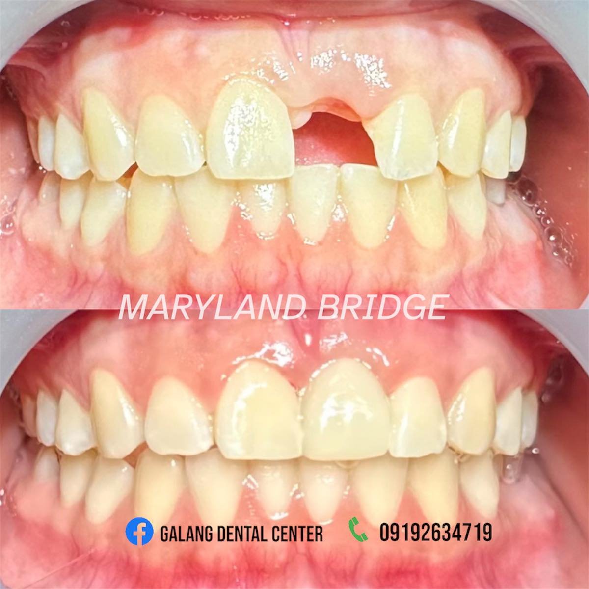 Dental Implant