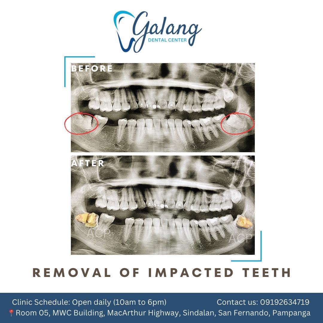 galang dental odontectomy
