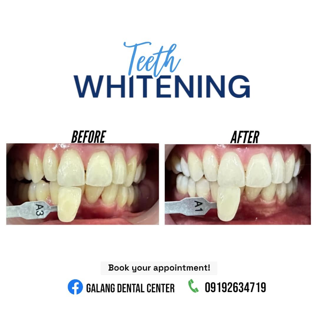 Cosmetic Dentistry 3 galang dental teeth whitening1
