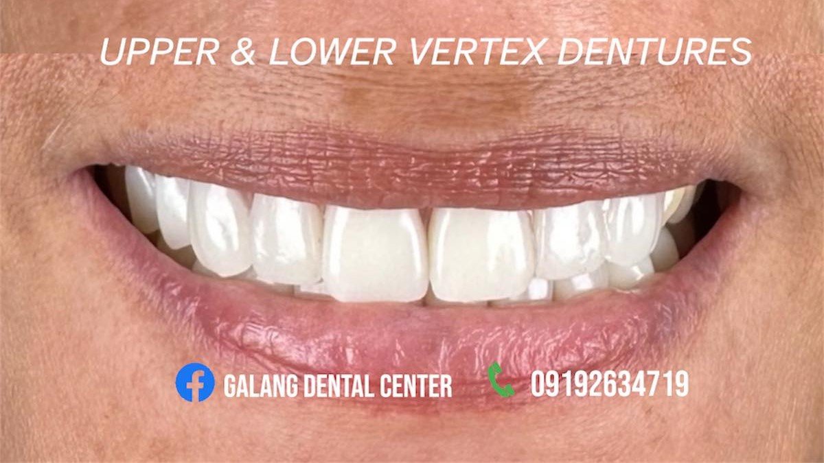 Home 10 Affordable Teeth Whitening in San Fernando Pampanga