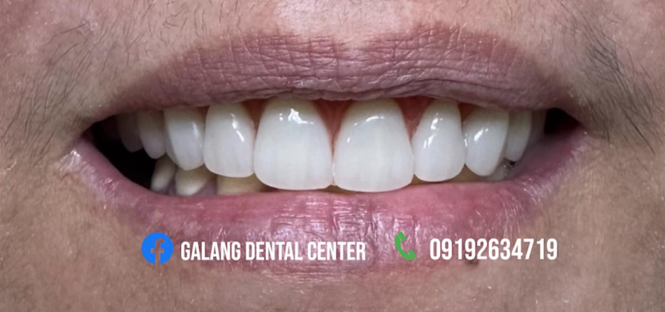 Affordable Teeth Whitening in San Fernando Pampanga
