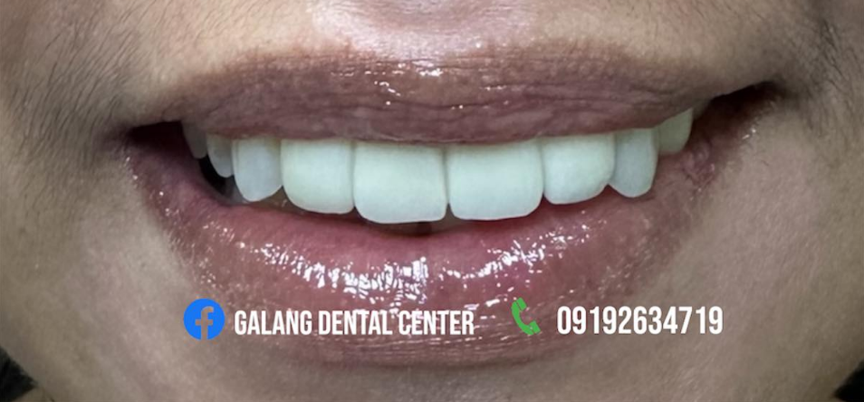 Tips to Prevent Toothaches and Cavities With Galang Dental Center 3 Tips to Prevent Toothaches and Cavities With Galang Dental Center