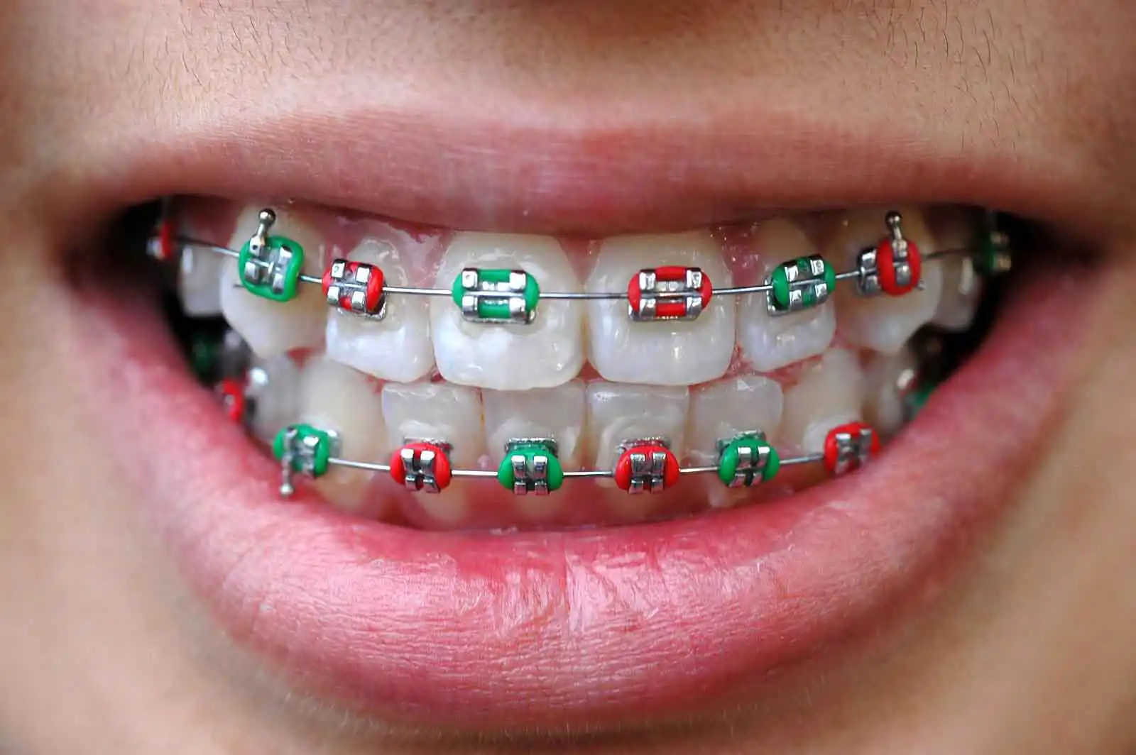 affordable braces consultation in san fernando pampanga