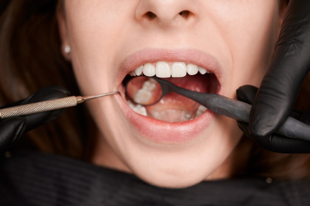 Tooth Extraction Cost San Fernando Pampanga dental procedure